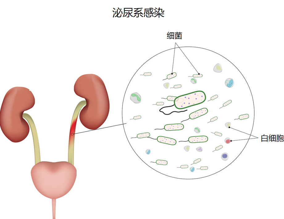 三伏天尿路結(jié)石的“高發(fā)季”，有哪些常見(jiàn)誤區(qū)