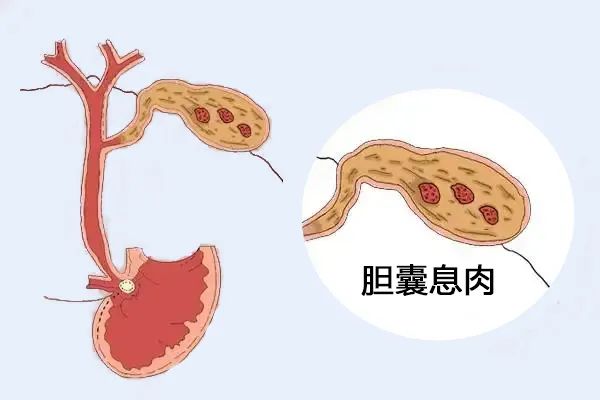 體檢出膽囊息肉，需要擔(dān)心嗎？