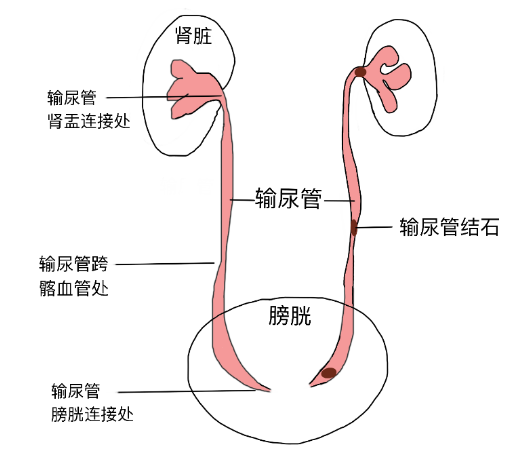 結(jié)石引發(fā)劇烈腎絞痛，該怎么辦？