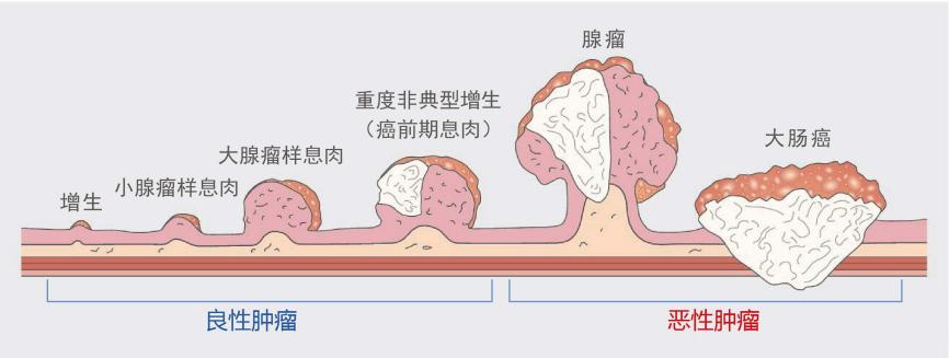 什么樣的腸息肉容易癌變？有一種要特別當(dāng)心！