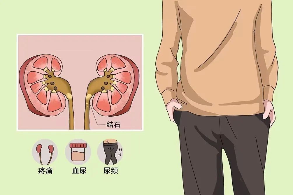 為什么很多人得腎結(jié)石？有2個習(xí)慣不要碰，腎會感激你