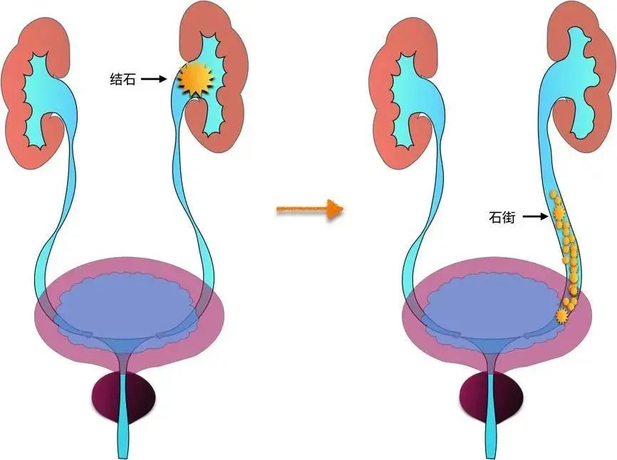 你經(jīng)歷過(guò)腎絞痛嗎？該如何緩解治療？