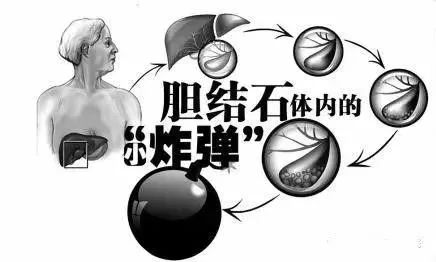 膽囊里的小結(jié)石要緊嗎？長大后再處理行不行？