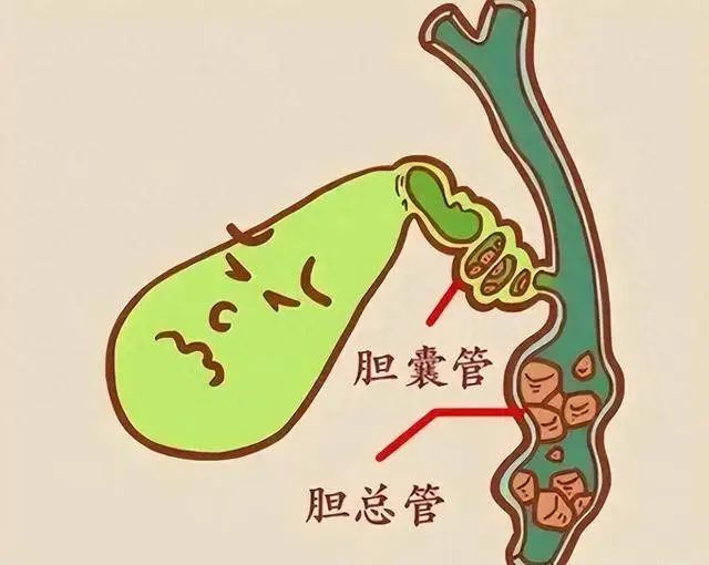 膽囊增大別視若無睹，可能背后潛伏了這幾頭“狼”！